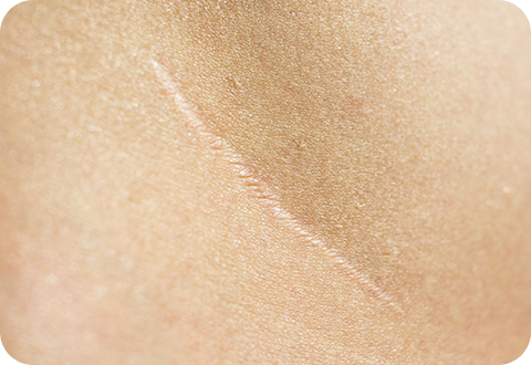 CO2 Laser - LP 3 c02 laser 02