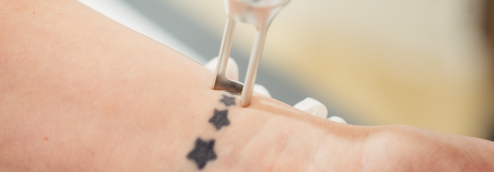 tattooentfernung header